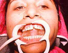 Midline gap between teeth 